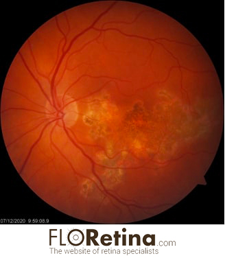 TUBERCULOUS SERPIGINOUS-LIKE CHOROIDITIS 1