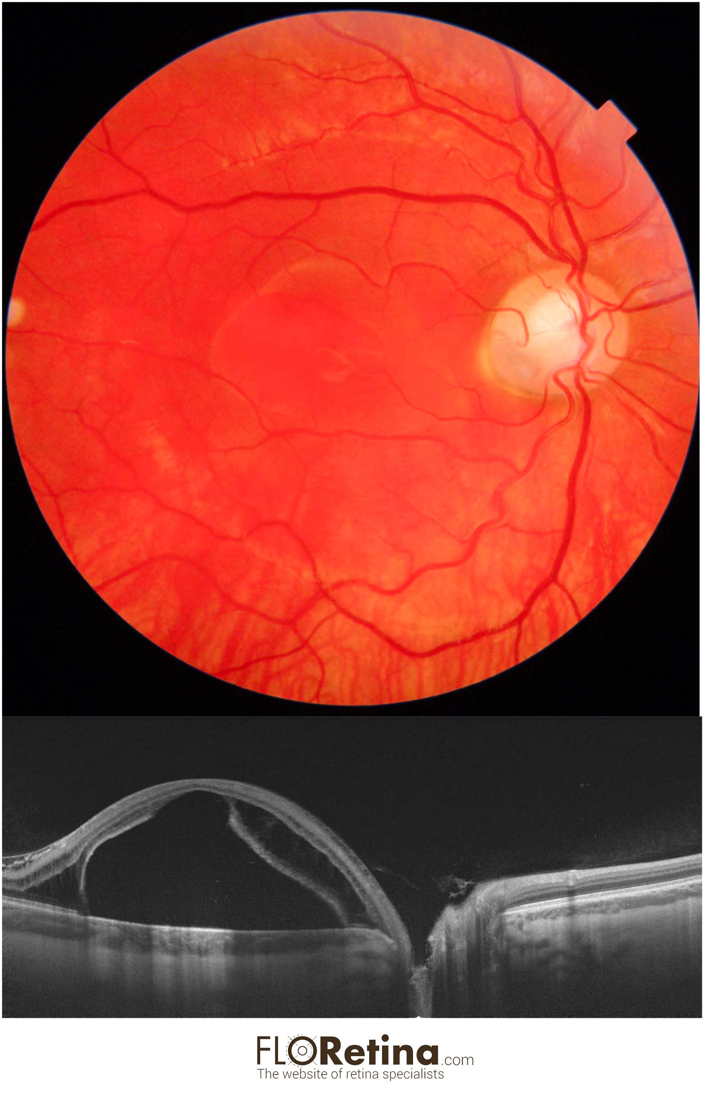 OPTIC DISK PIT