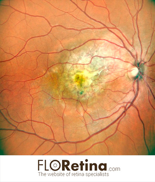 CHOROIDAL OSTEOMA complicated by choroidal neovascularization