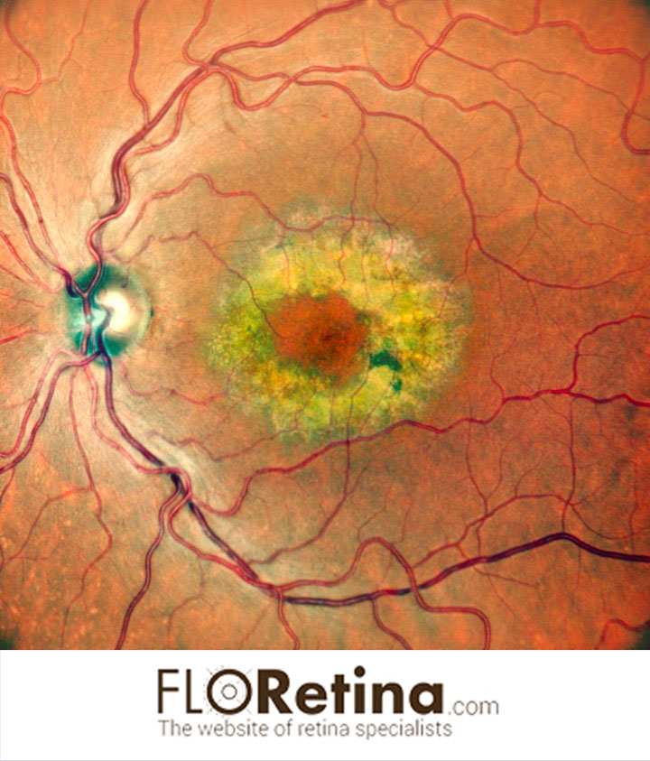 Benign Concentric Annular Macular Dystrophy