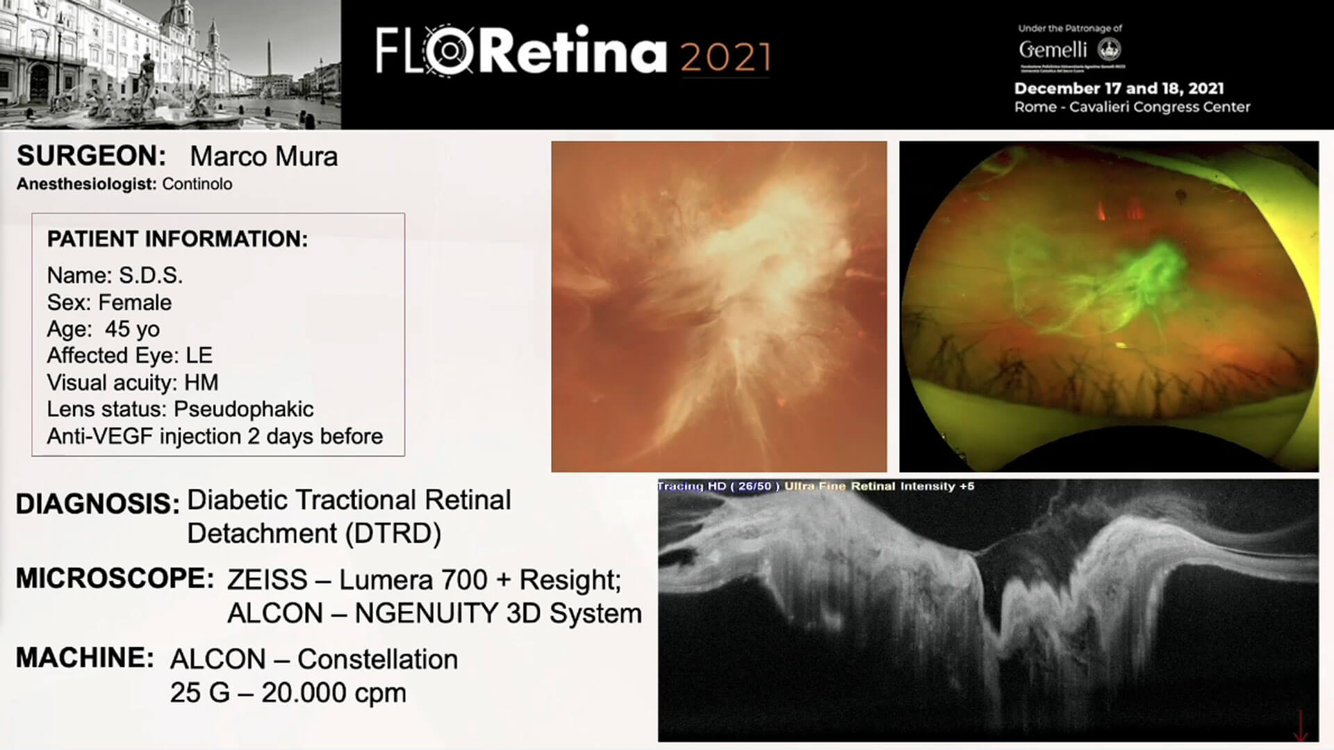 Diabetic Tractional Retinal Detachment (DTRD)