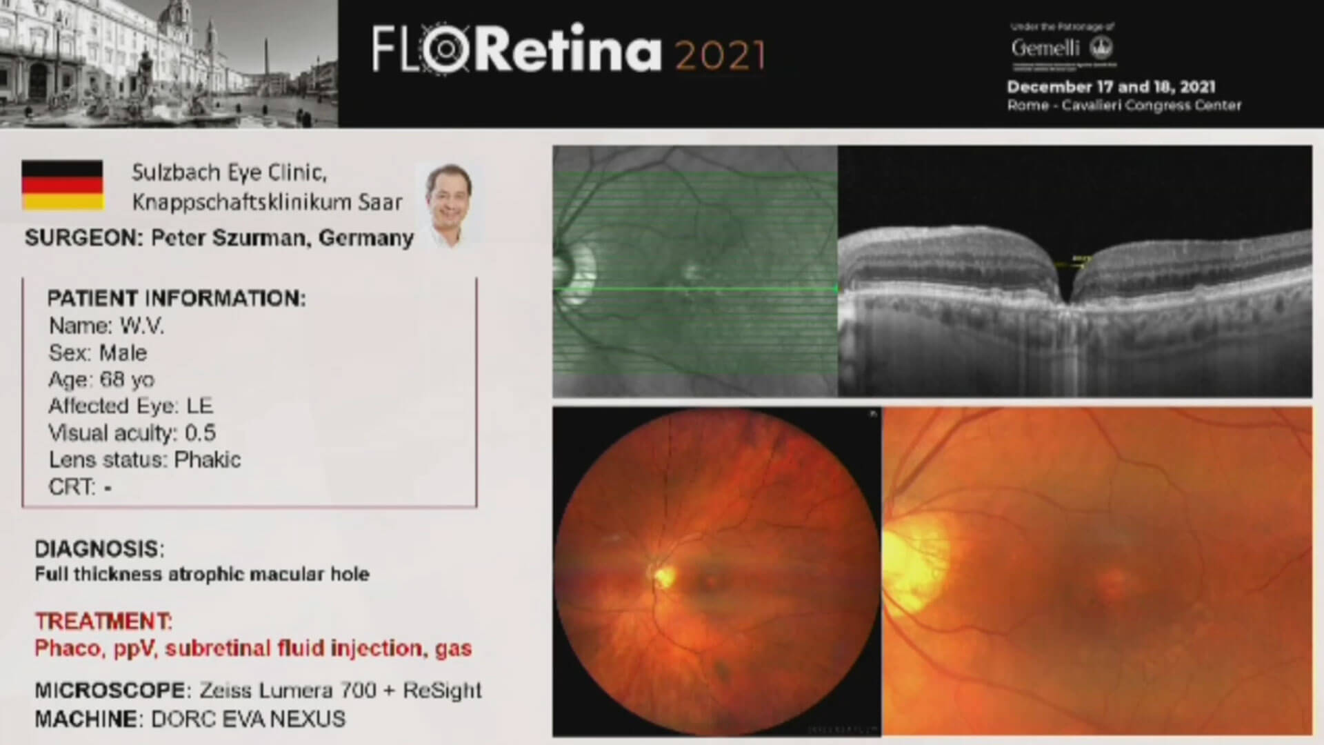 Full Thickness Atrophic Macular Hole