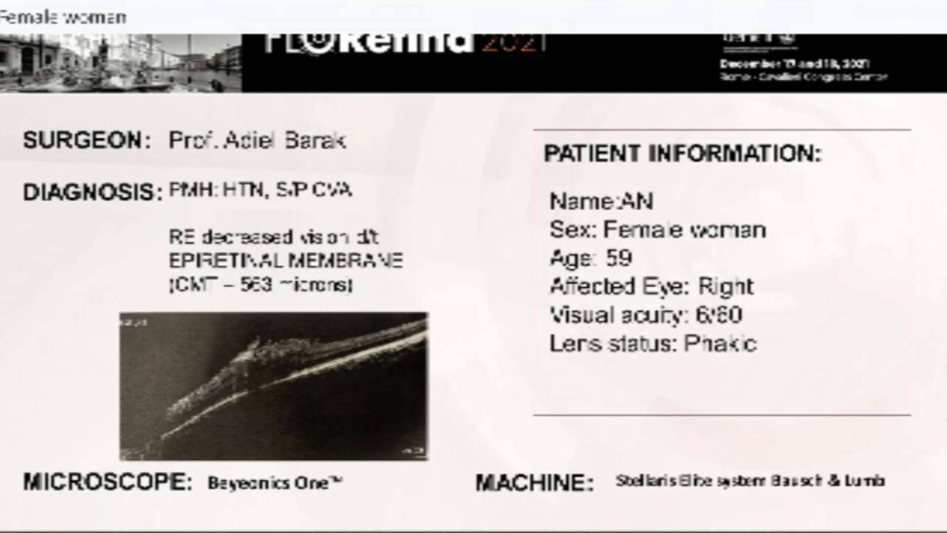 PMH, RE decreased vision EPIRETINAL MEMBRANE