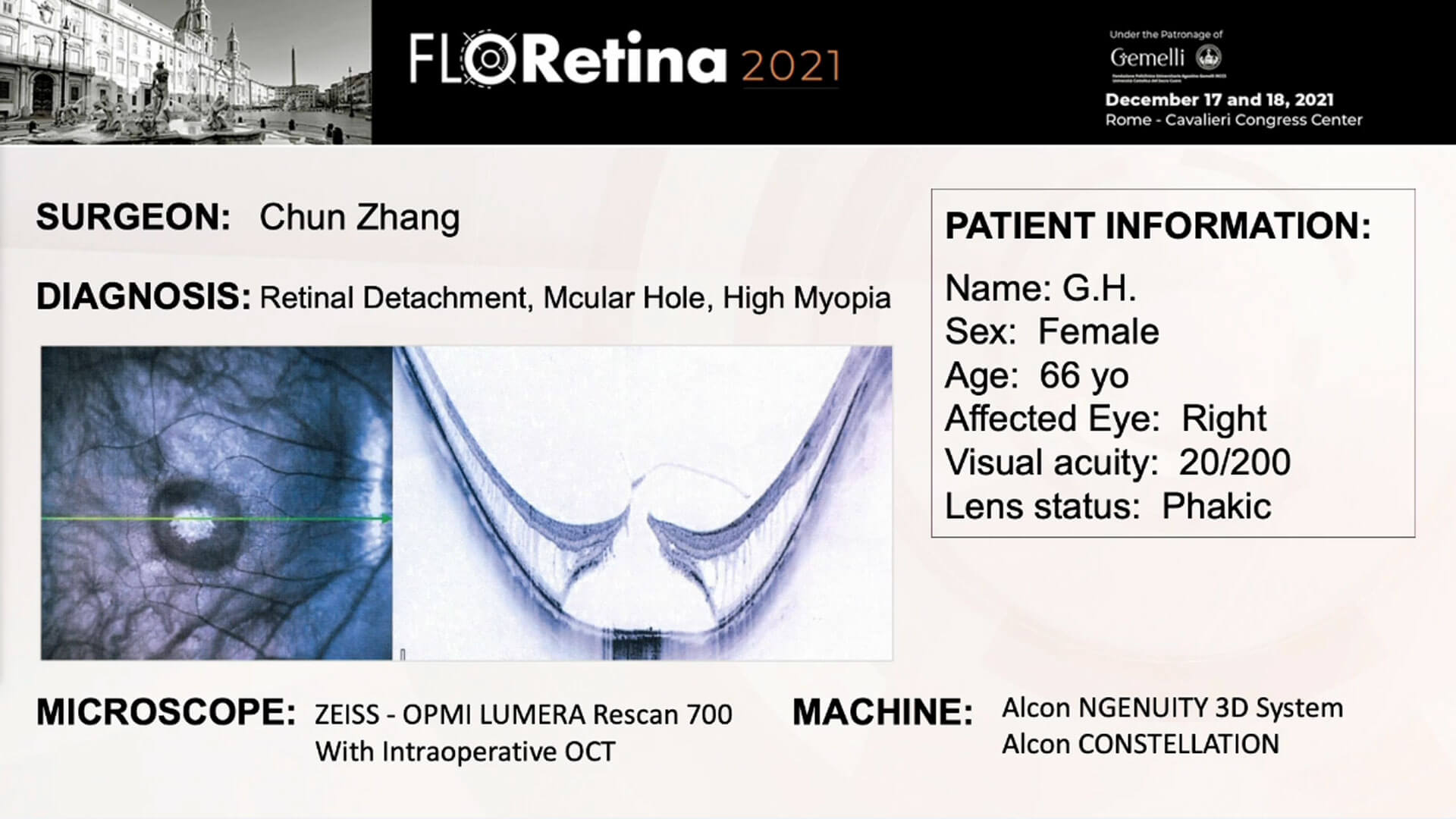 Retinal Detachment, Macular Hole, High Myopia