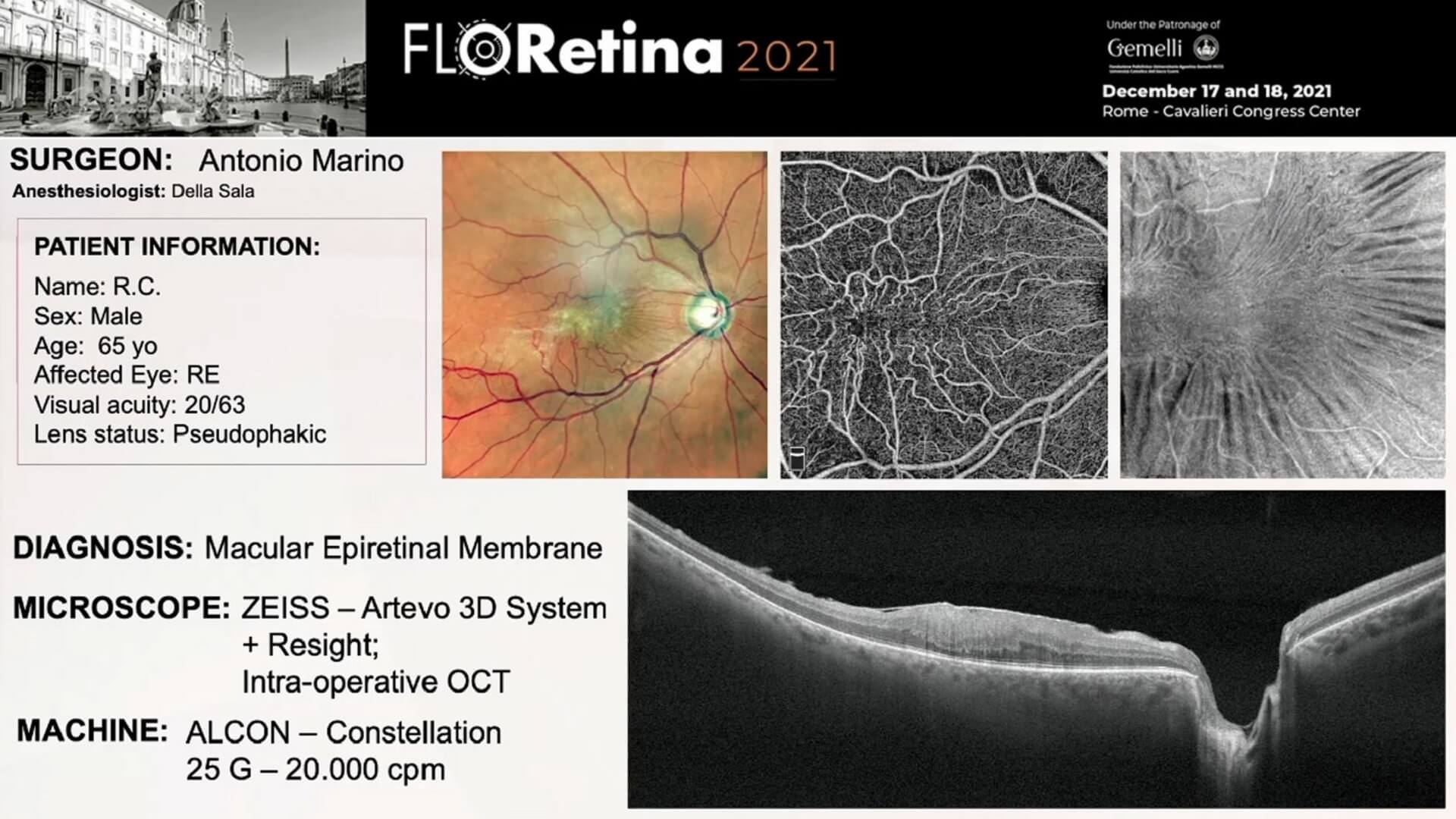 Macular Epiretinal Membrane