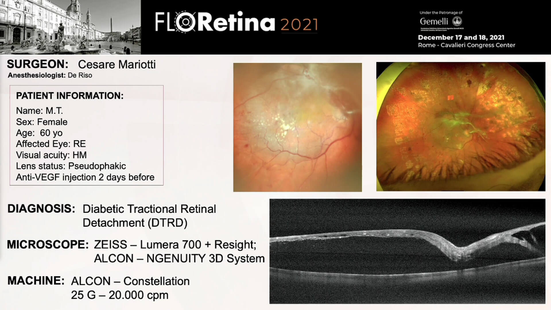 Diabetic Tractional Retinal Detachment (DTRD)