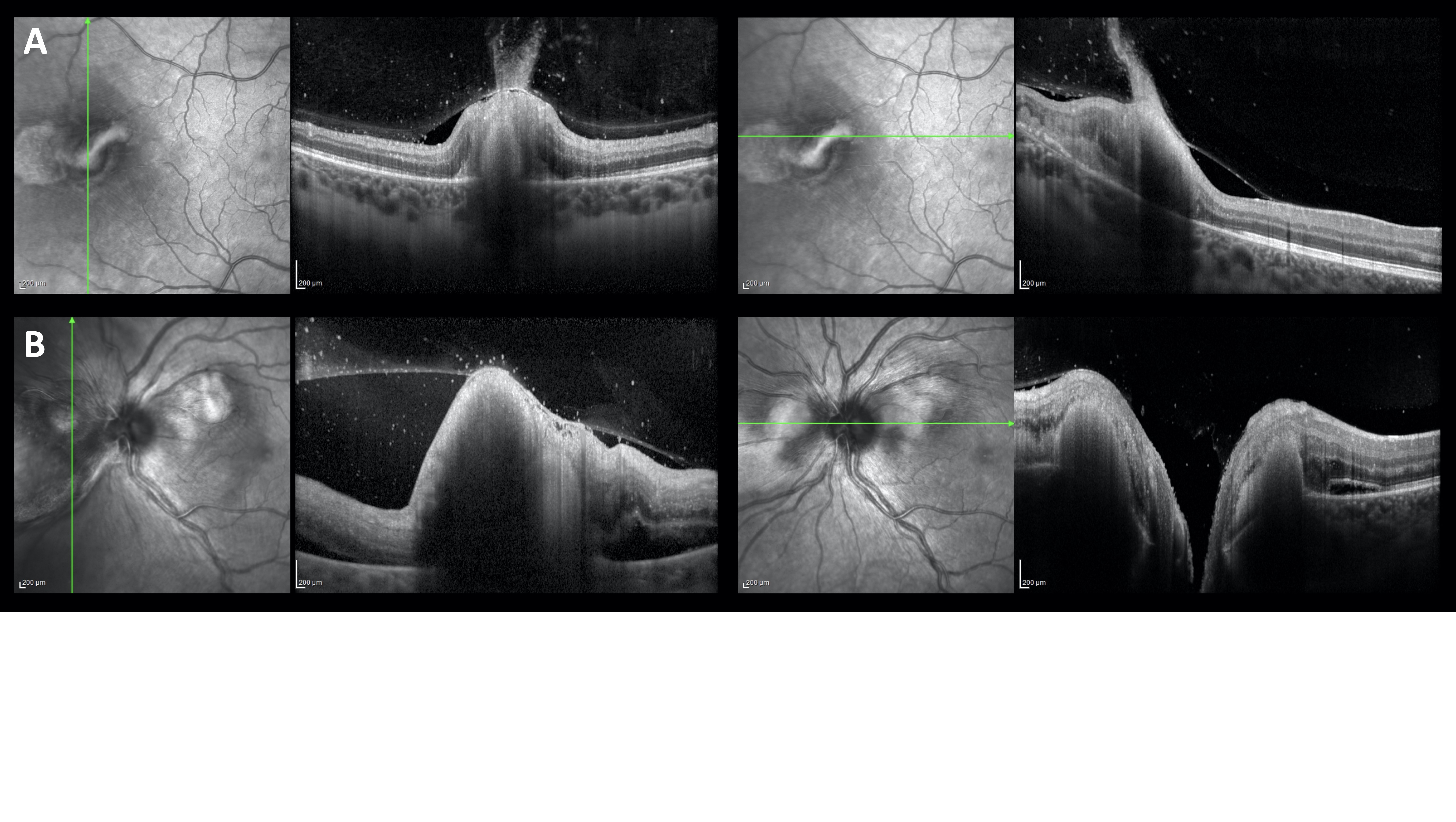 Bilateral Candida albicans chorioretinitis