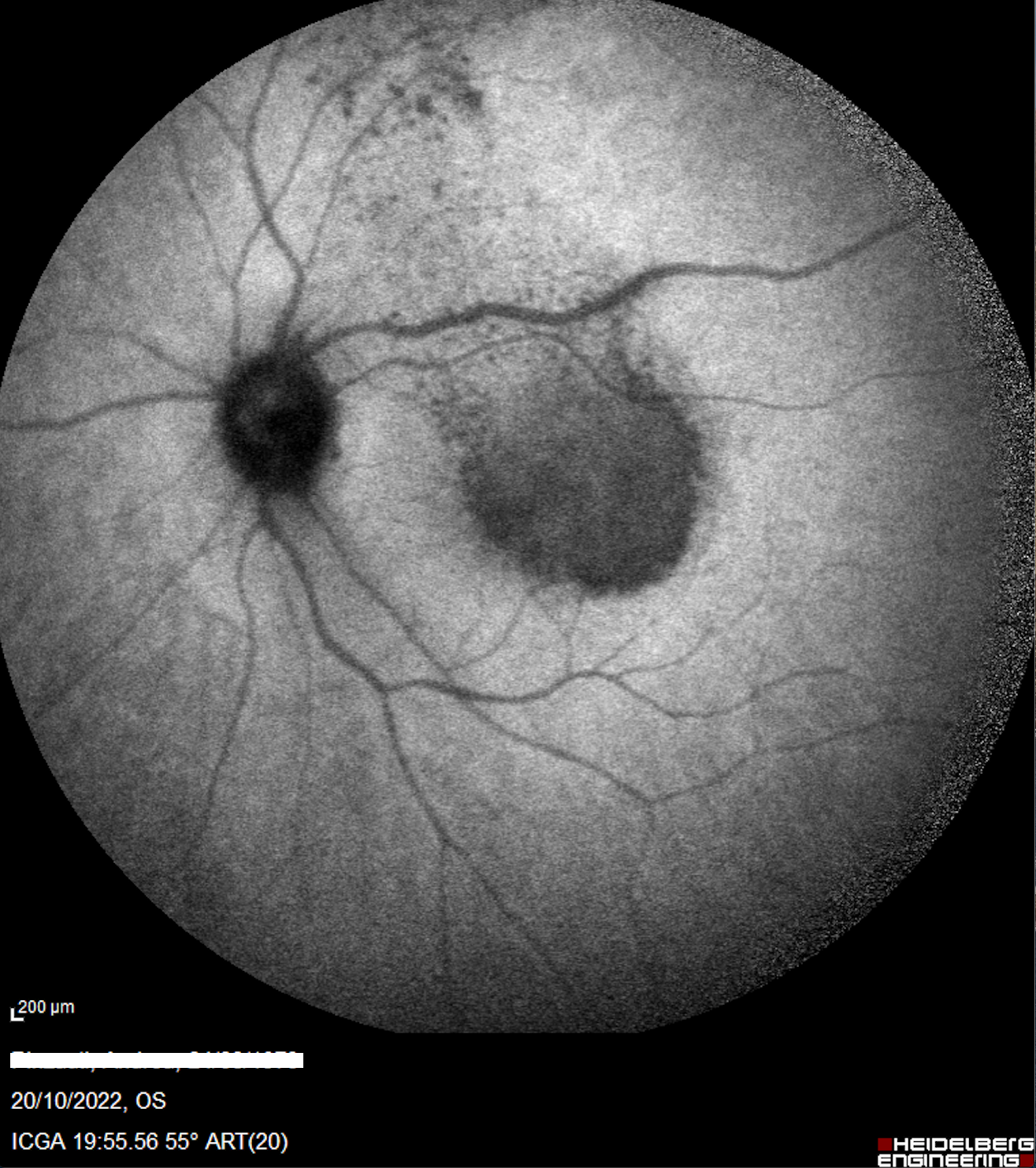 Syphilitic posterior placoid chorioretinitis