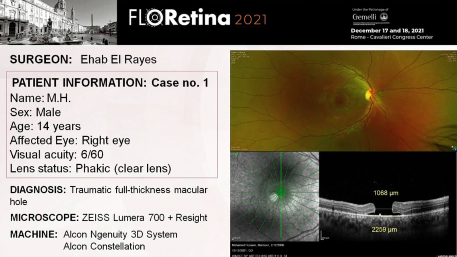 Traumatic full-thickness macular hole