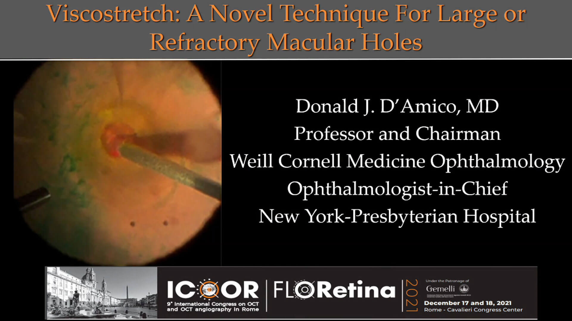 Viscostretch, a New Technique for Mediumsized Failed Macular Holes