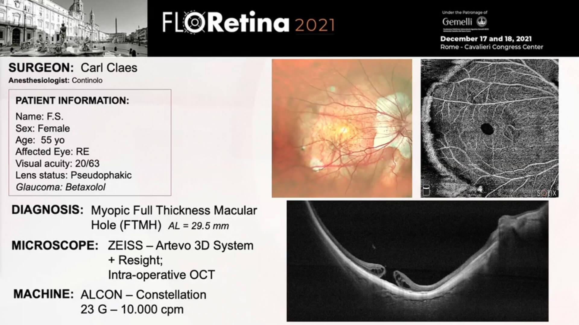 Myopic Full Thickness Macular Hole (FTMH)