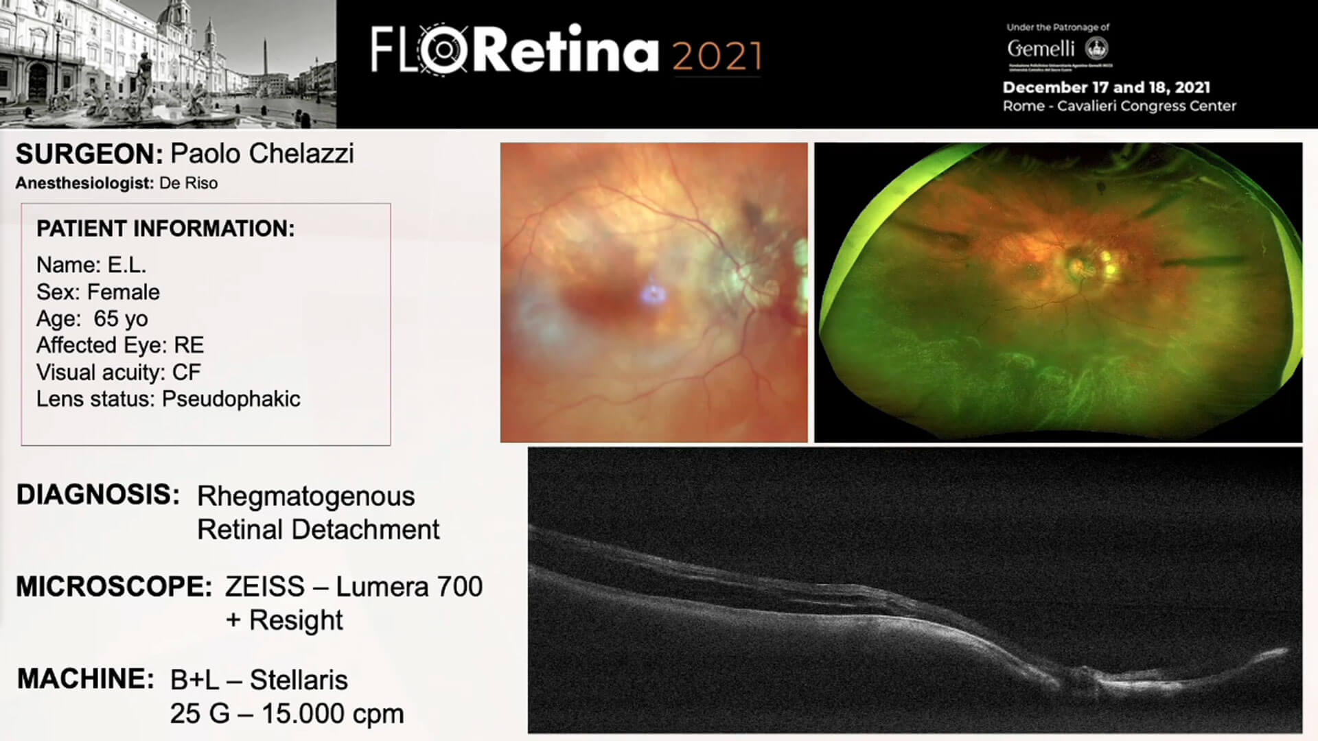 Rhegmatogenous Retinal Detachment