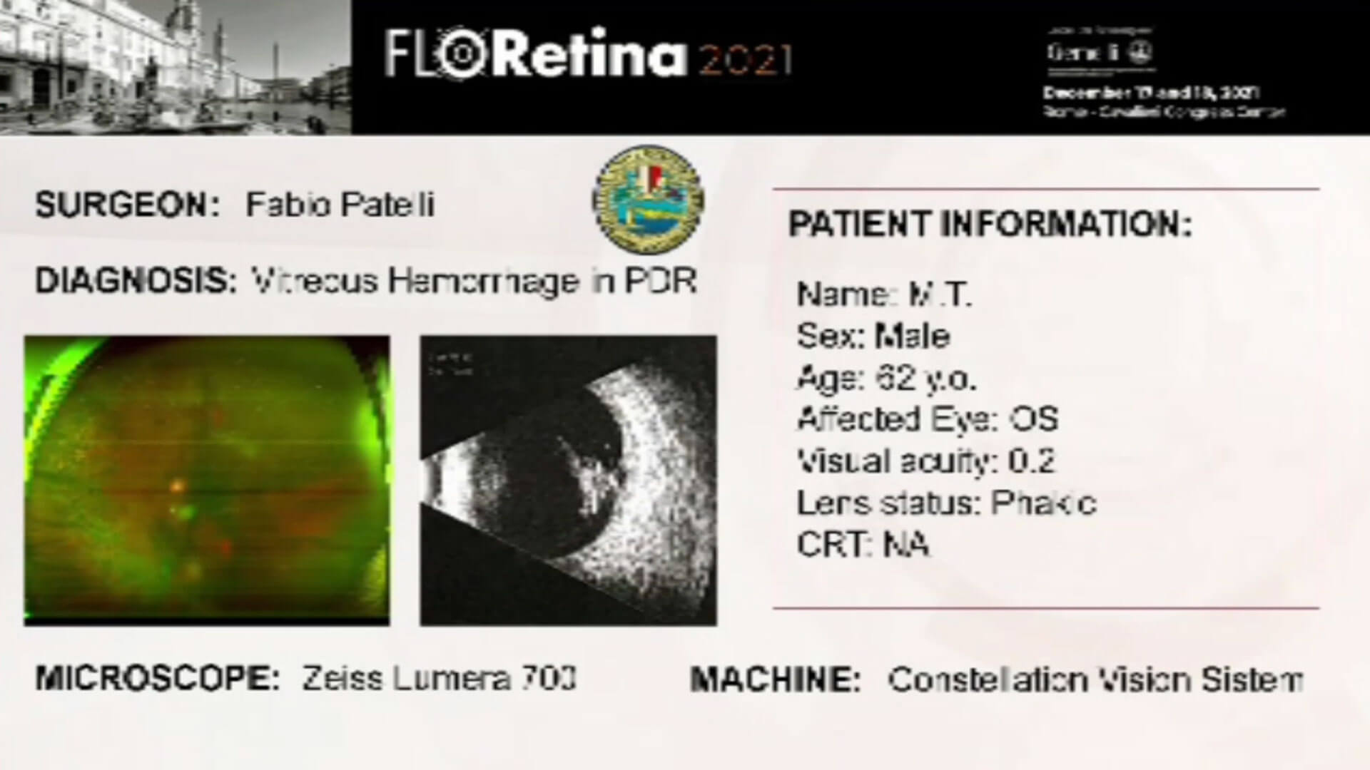 Vitreous Hemorrhage in PDR