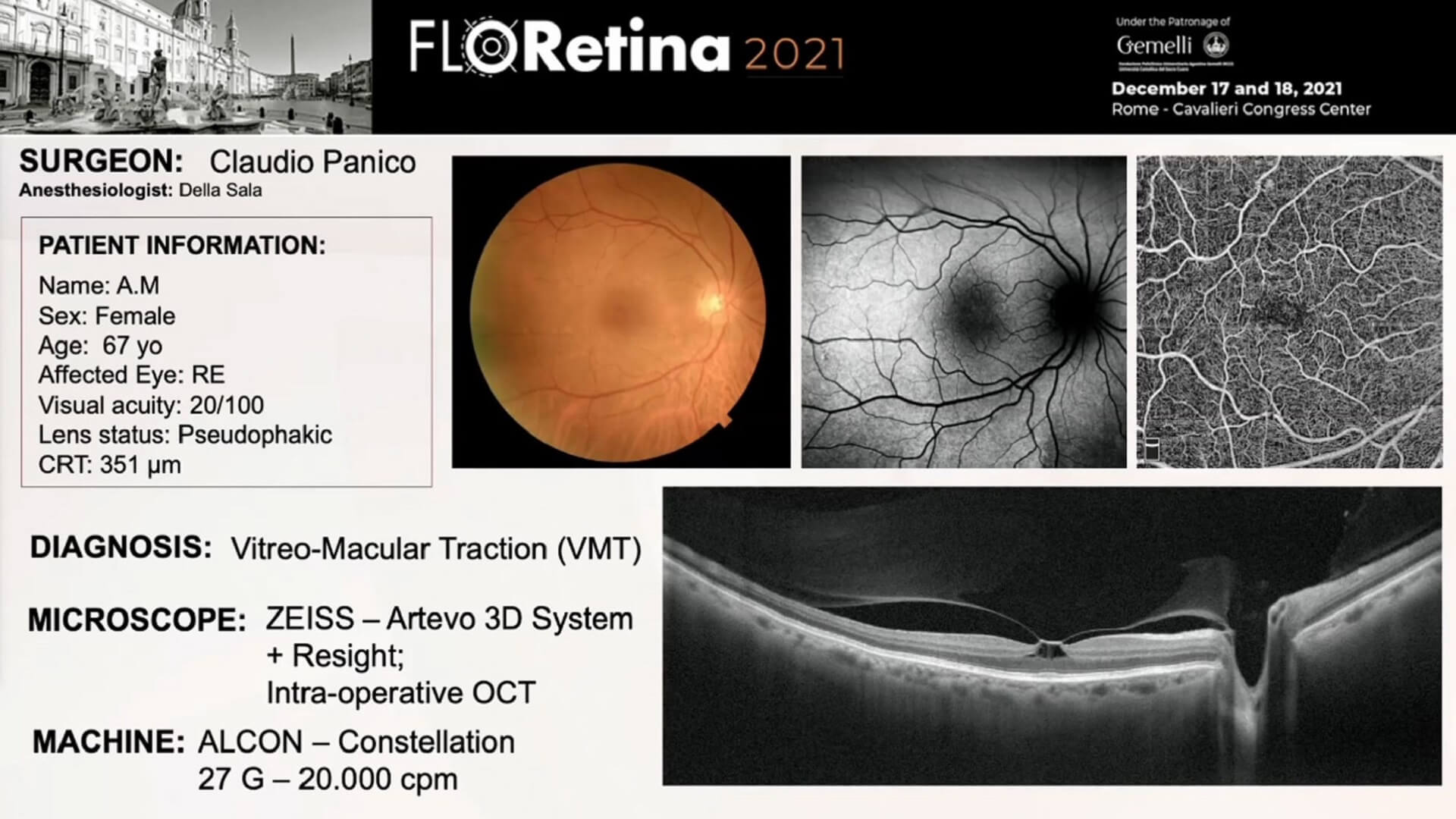 Vitreo-Macular Traction (VMT)