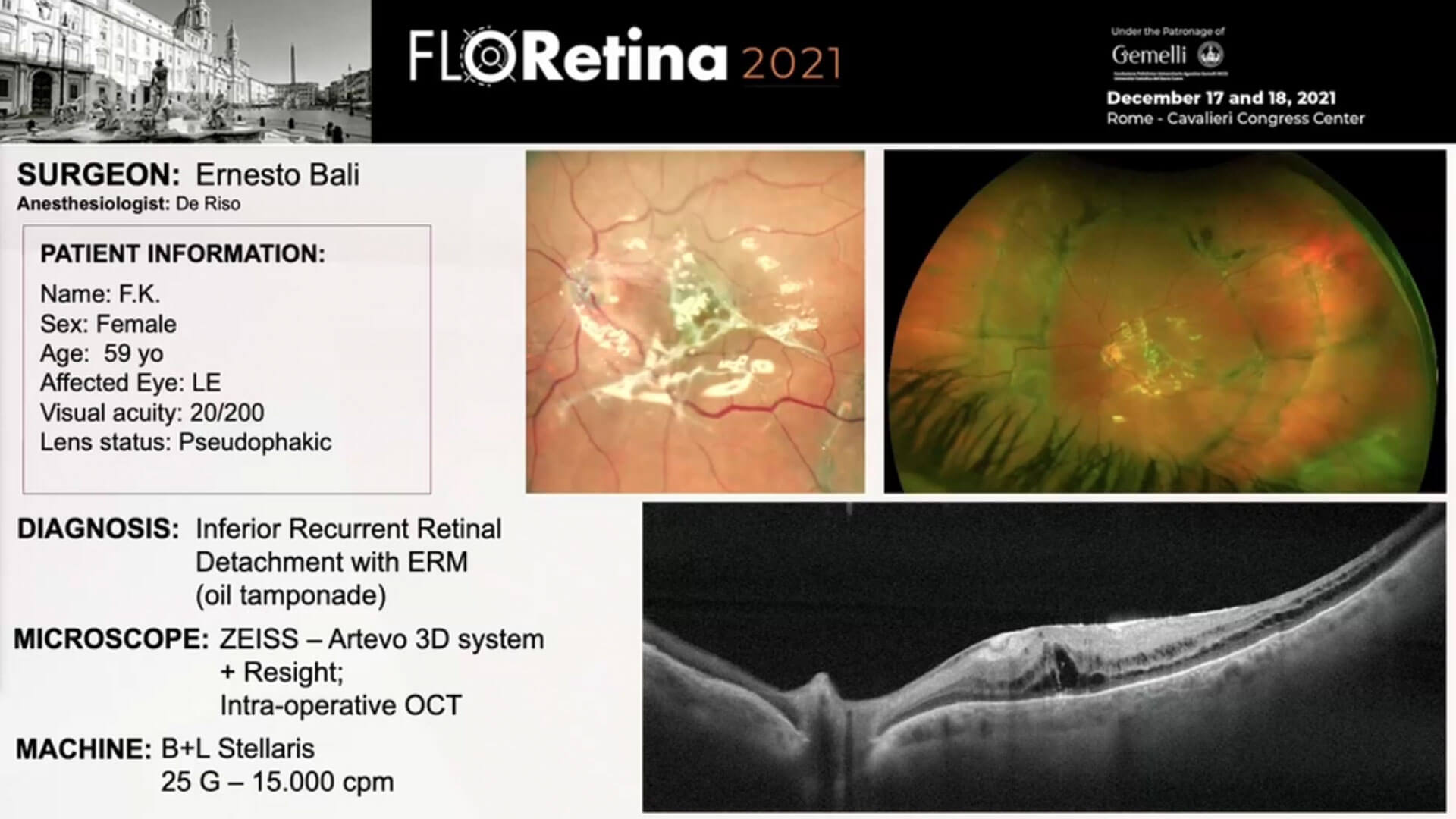 Inferior Recurrent Retinal Detachment with ERM (oil tamponade)