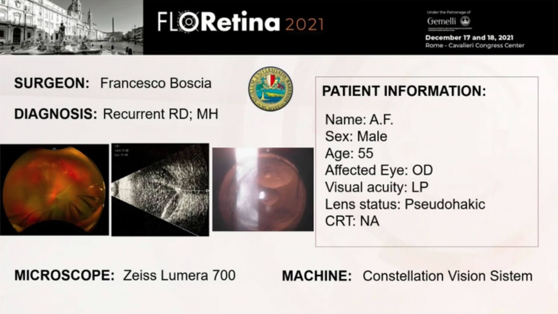 Recurrent RD; MH