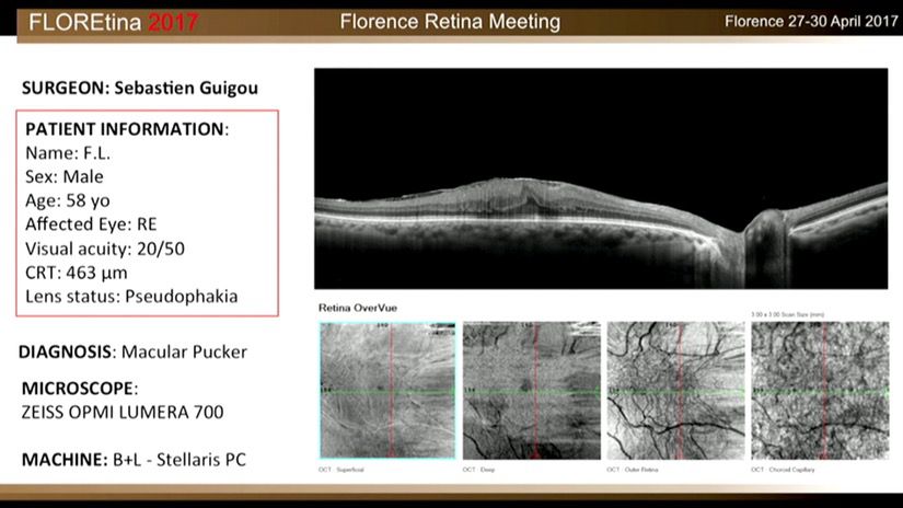 Macular Pucker