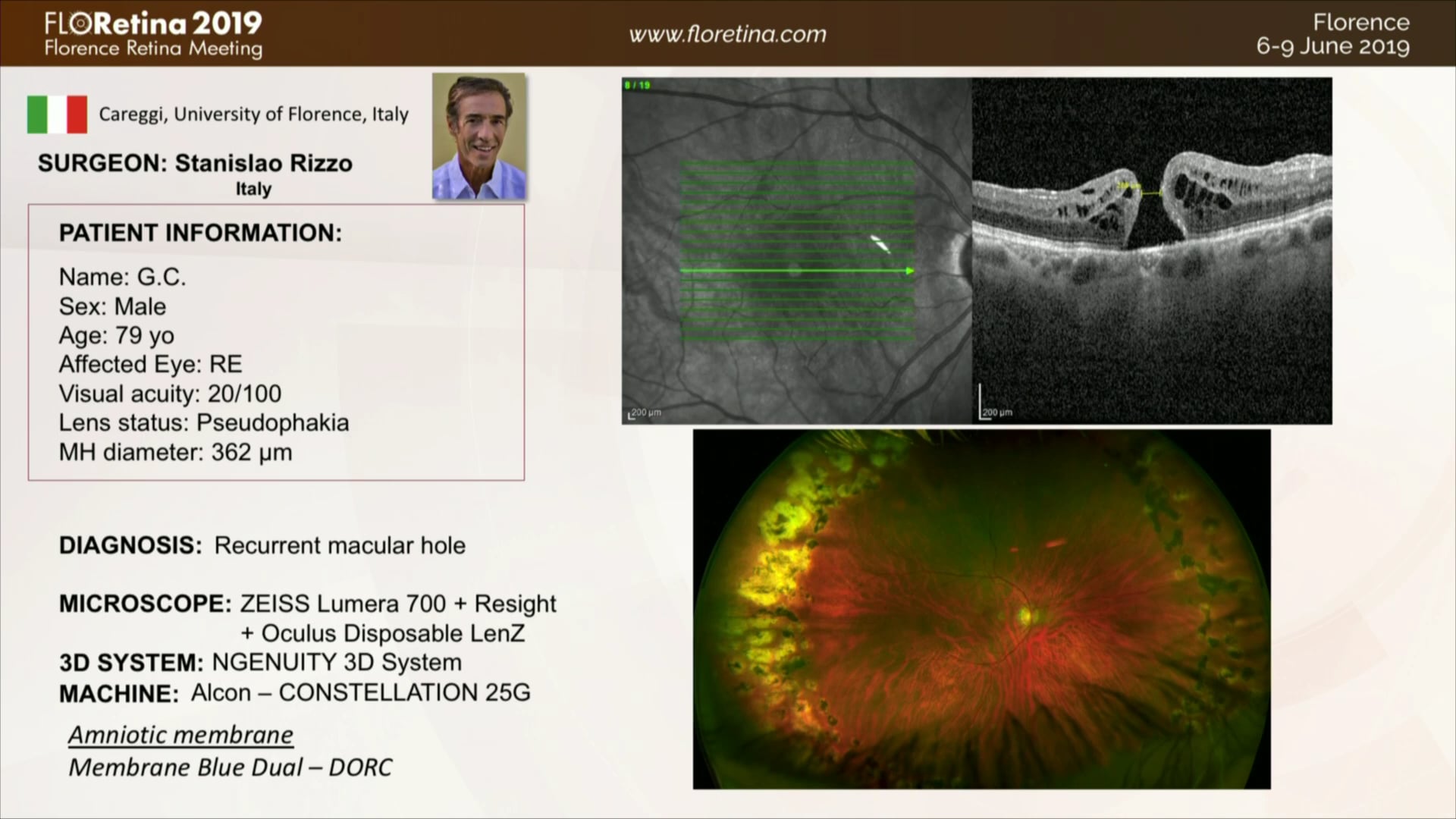 Macular Hole