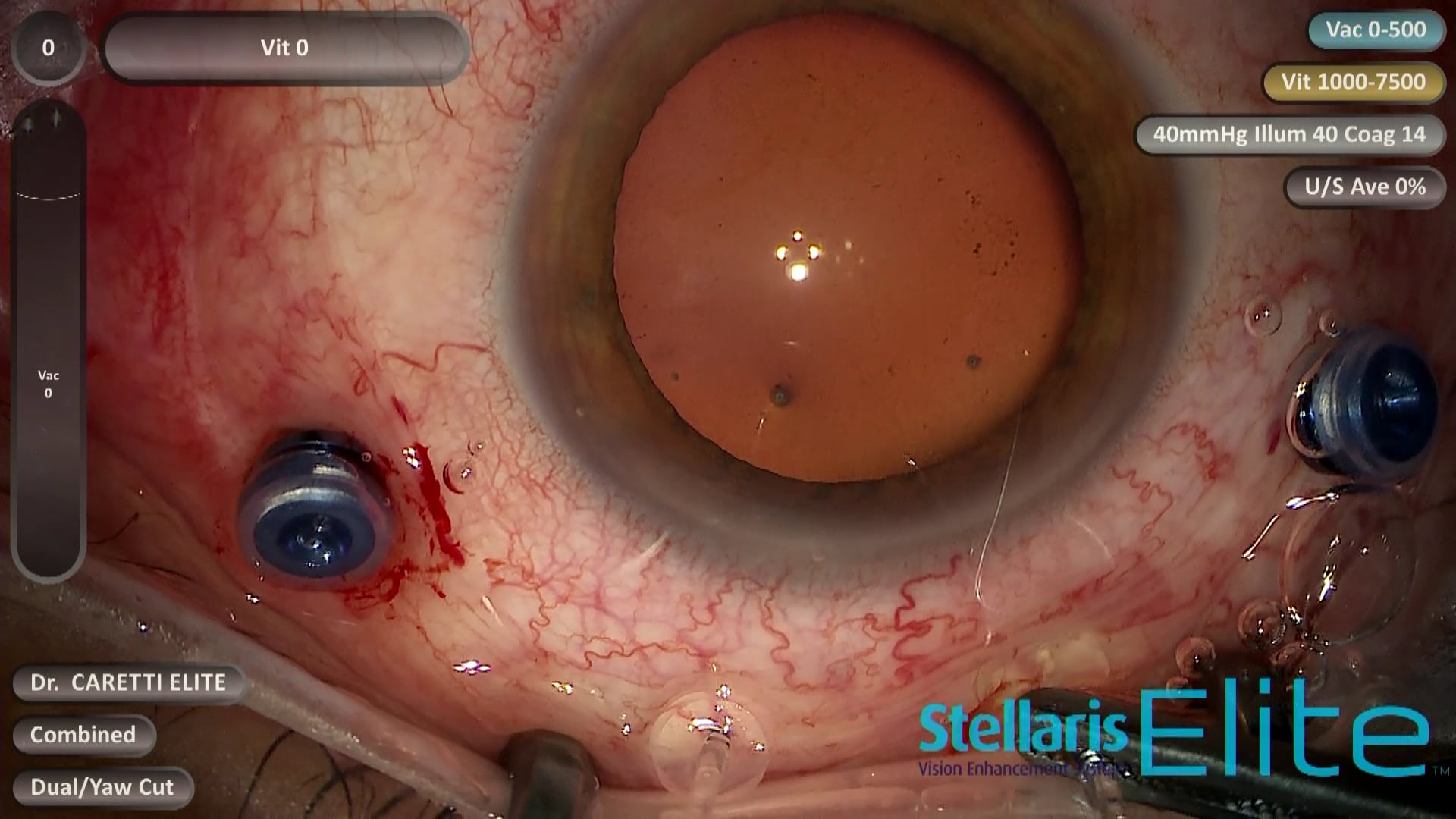 Optic Disc Pit With Macular Retinoschisis and RD