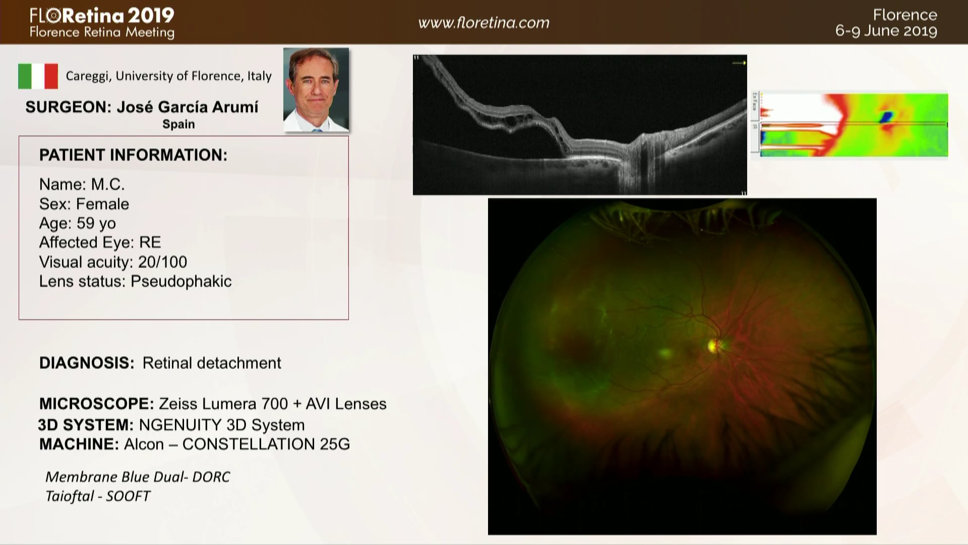 Retinal Detachment