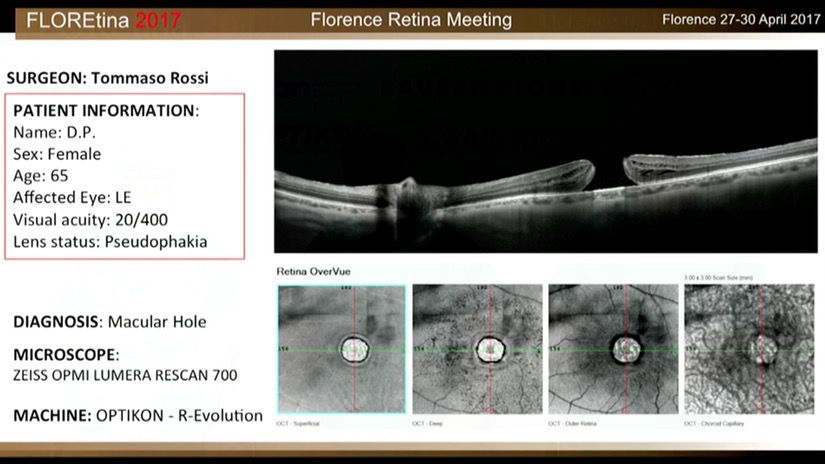 Macular Hole