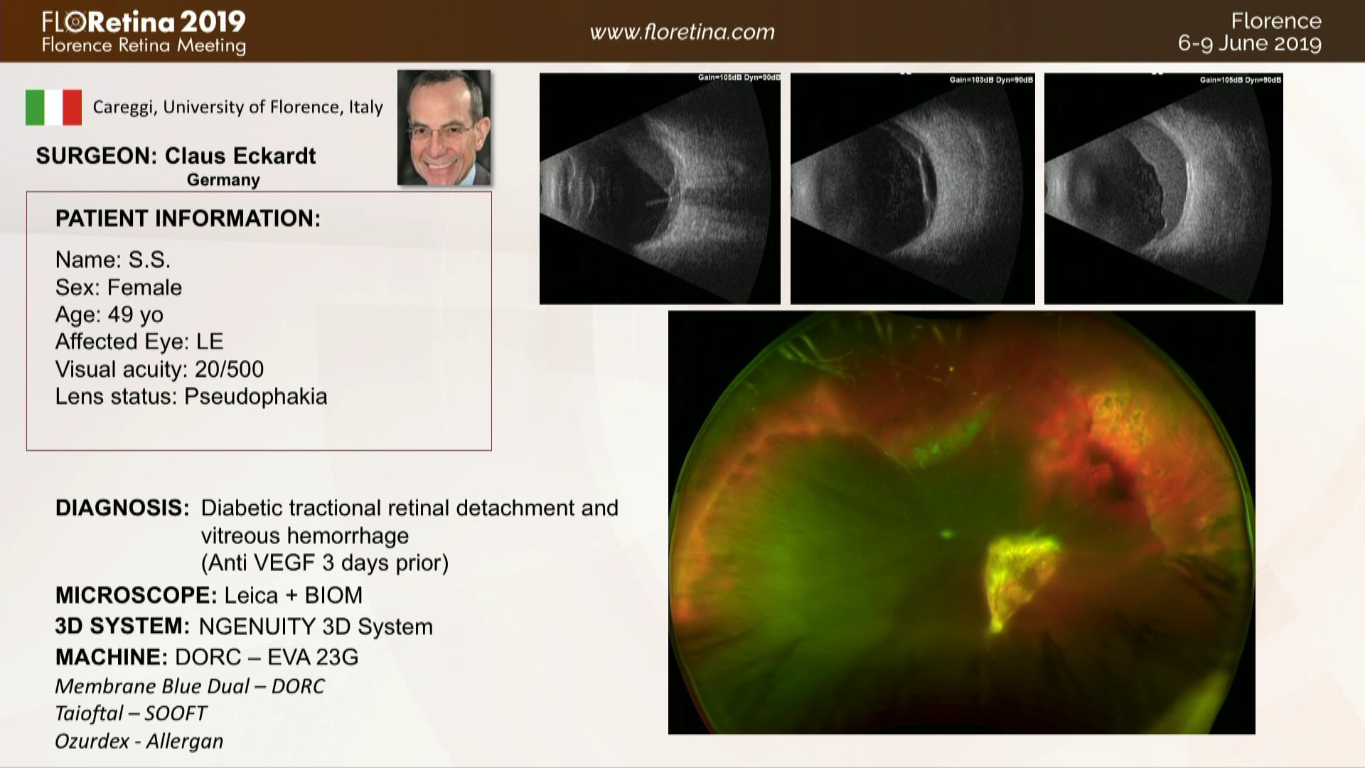 Diabetic Tractional Retinal Detachmente And Vitreous Hemorrhage