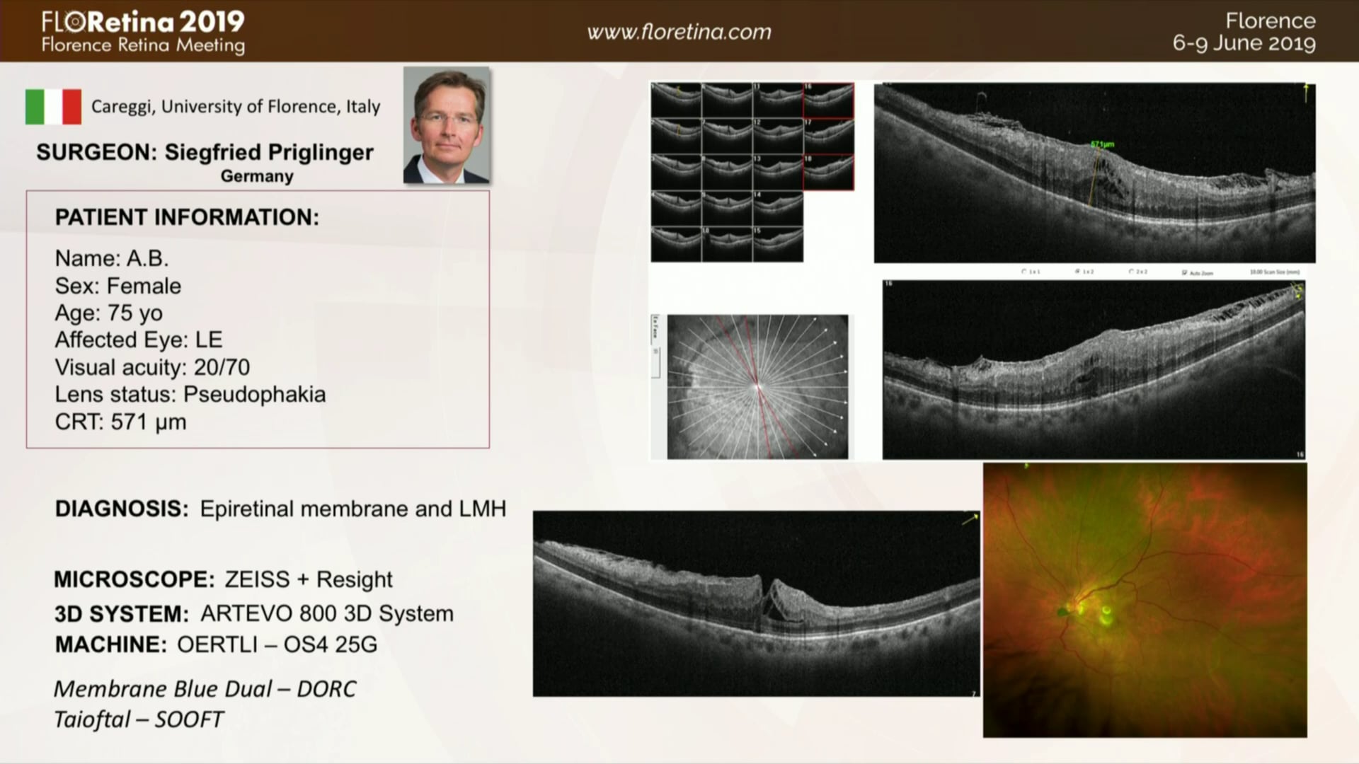 Epiretinal Membrane and LMH