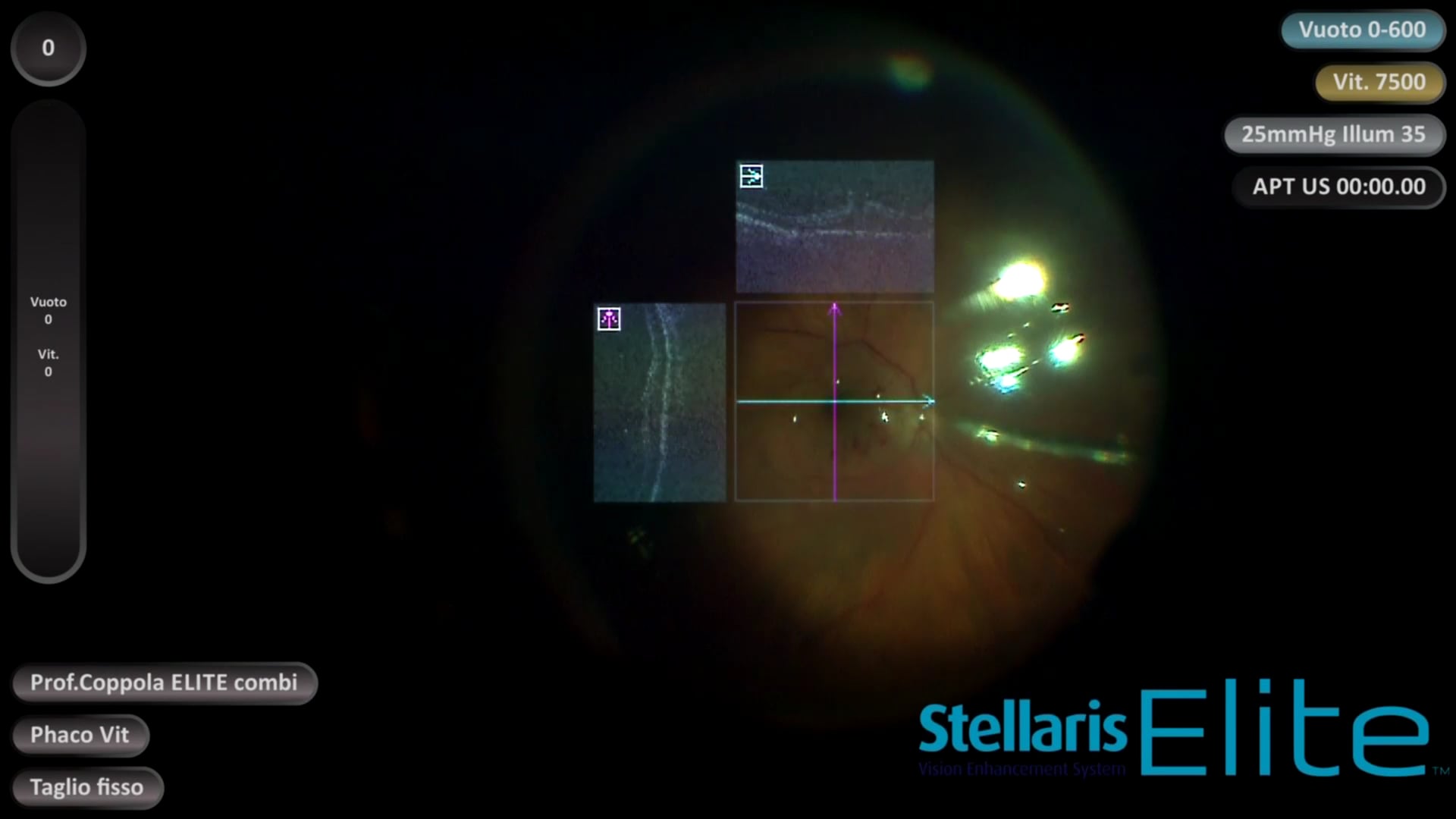 Full Thickness Macular Hole