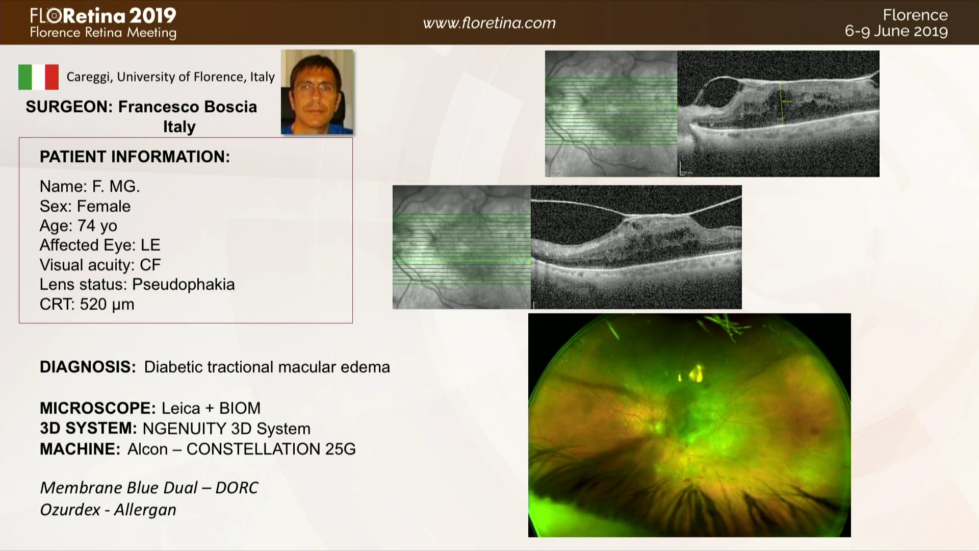 Diabetic Tractional Macular Edema