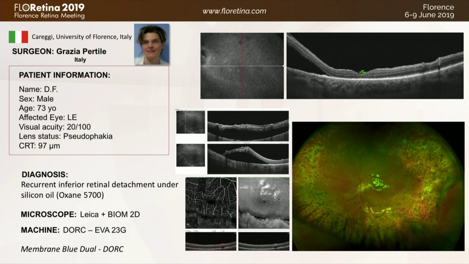 Recurrent Inferior Retinal Detachment Under Silicone Oil