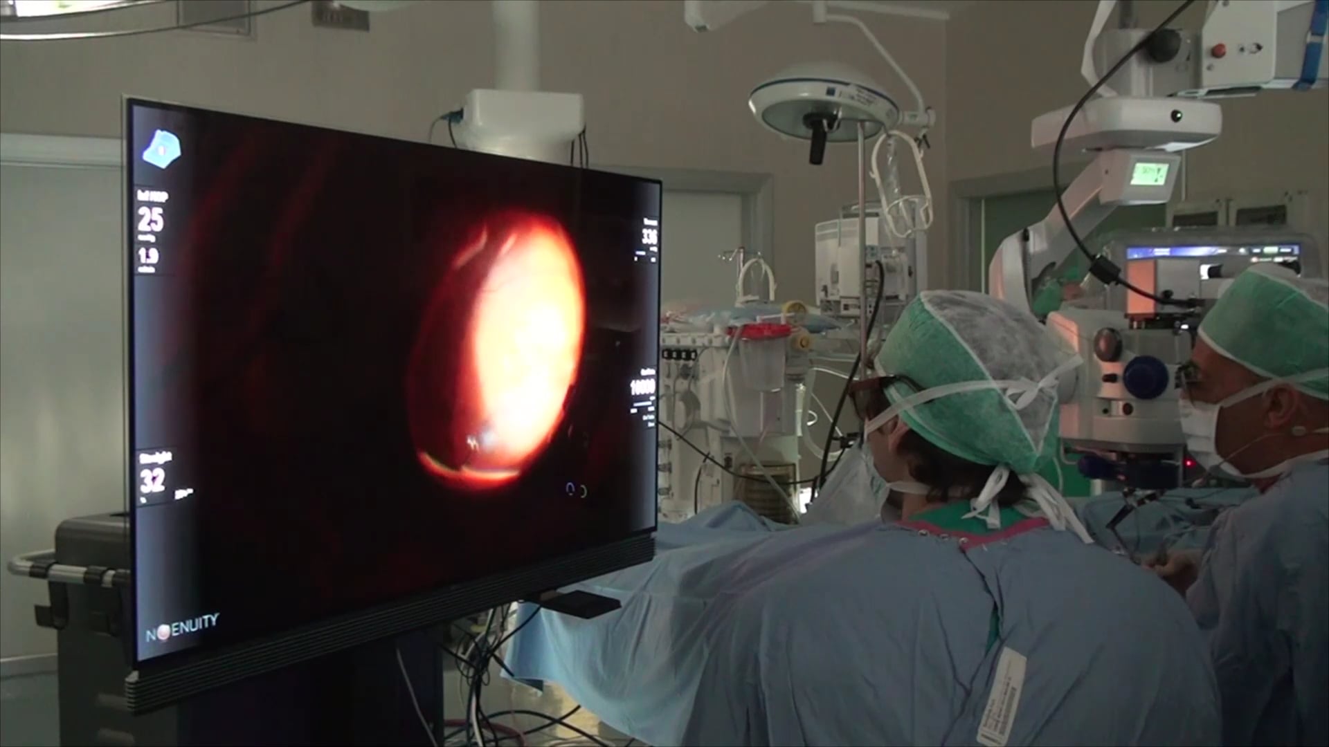 Rhegmatogenous Retinal Detachment