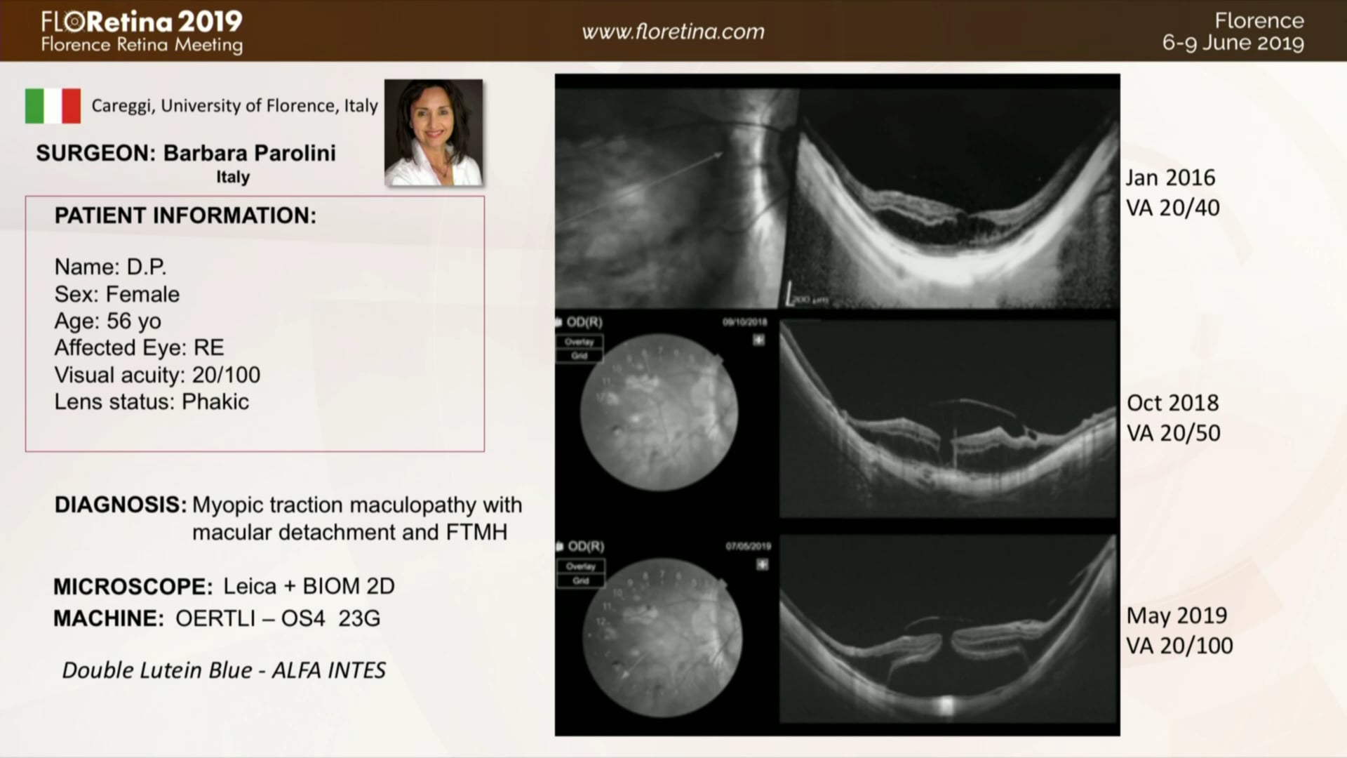 Myopic Traction Maculophaty With Macular Detachment And FTMH