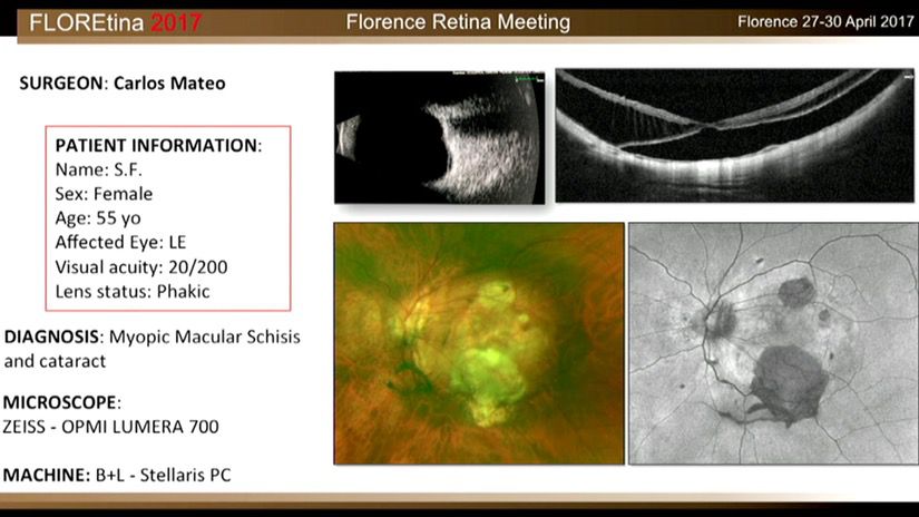 Myopic Macular Schisis And Cataract