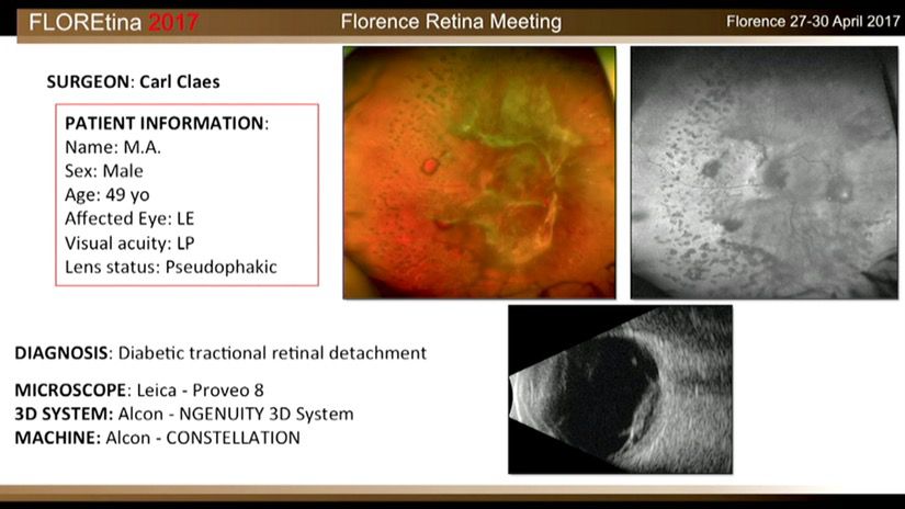 Diabetic Tractional Retinal Detachment