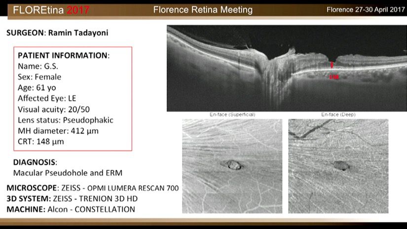 Macular Pseudohole And ERM