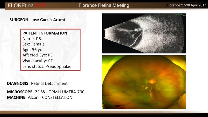 Retinal Detachment