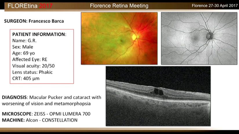 Macular Pucker And Cataract With Worsening Of Vision And Metamorphopsia