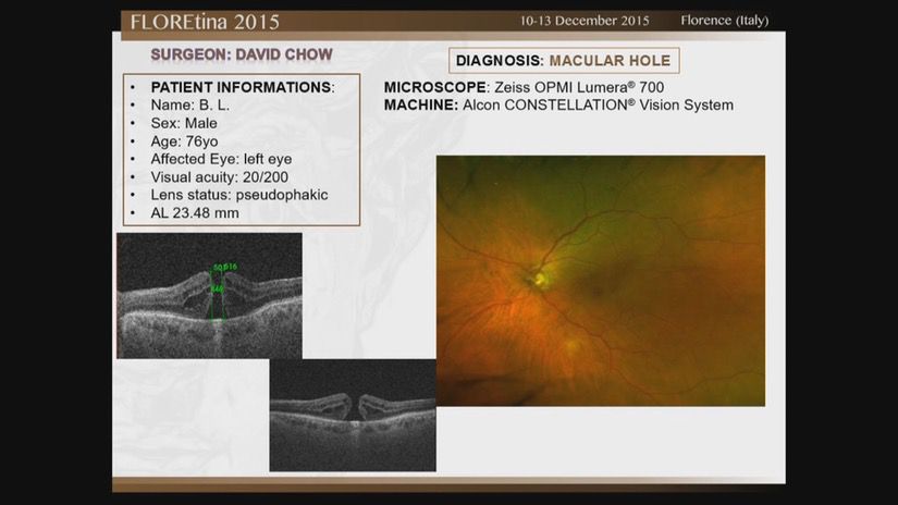 Macular Hole