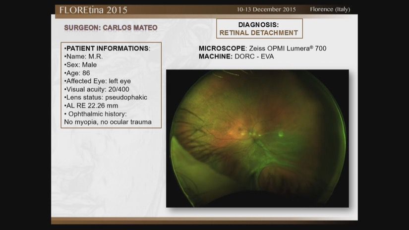 Retinal Detachment