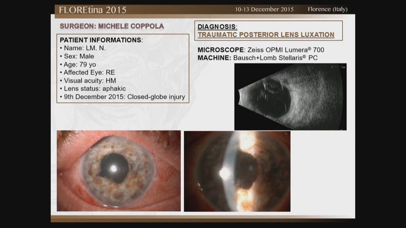 Traumatic Posterior Lens Luxation