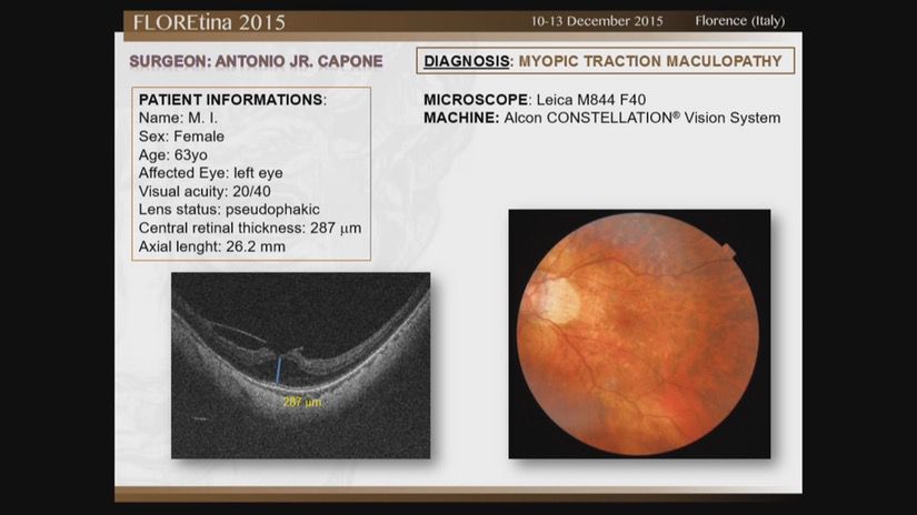 Myopic Traction Maculopathy