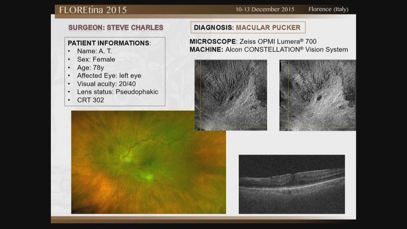 Macular Pucker