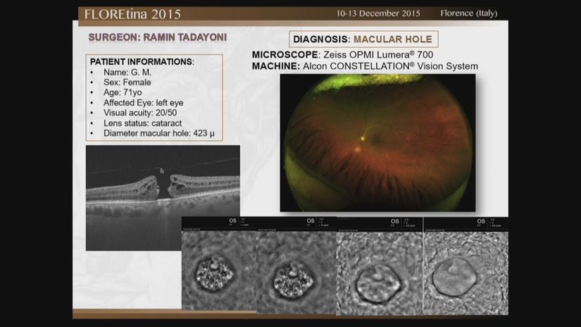 Macular Hole