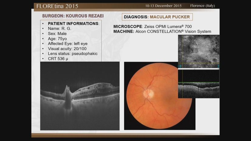 Macular Pucker