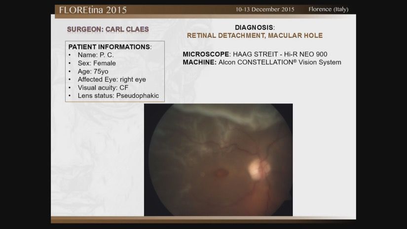 Retinal Detachment + Macular Hole