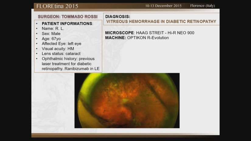 Vitreous Hemorrhage In Diabetic Retinopathy