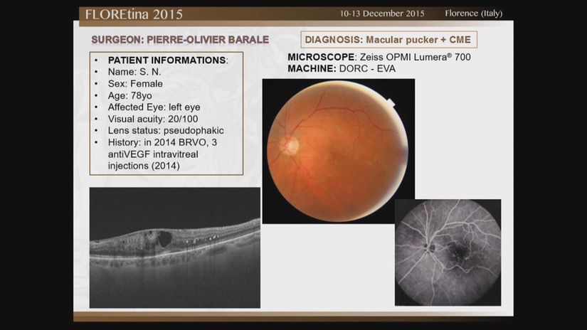 Macular Pucker