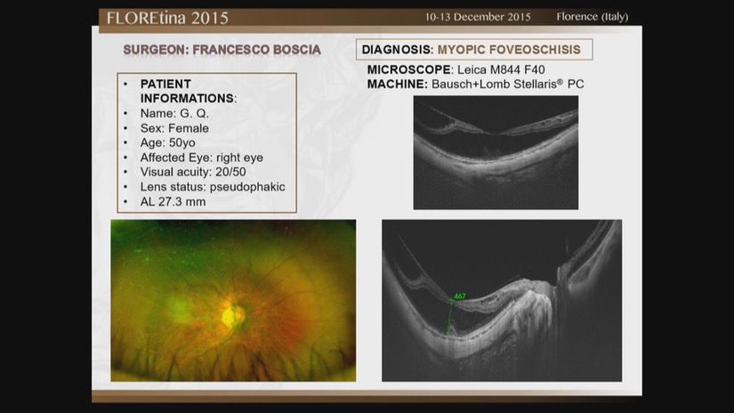 Myopic Foveoschisis