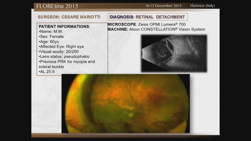 Retinal Detachment