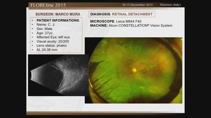 Retinal Detachment